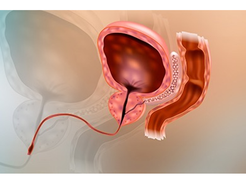 Urologist: Try This If You Have An Enlarged Prostate (Watch)