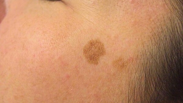 How To: Fix Dark Spots And Uneven Skin Tones
